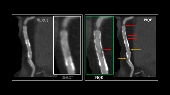 登陸中國(guó)，首款16cm光譜成像、超高清寬體CT國(guó)產(chǎn)上市(圖4)