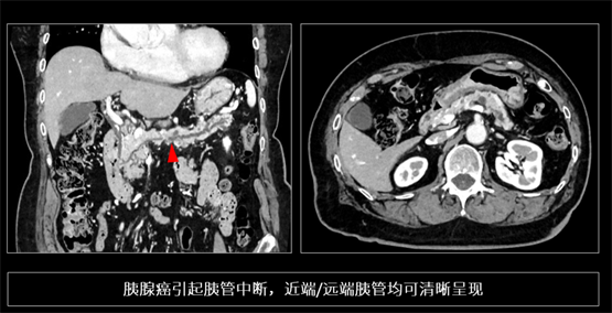 登陸中國(guó)，首款16cm光譜成像、超高清寬體CT國(guó)產(chǎn)上市(圖5)